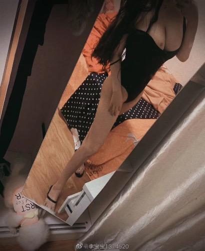 Lymphedema photo